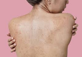 Body acne