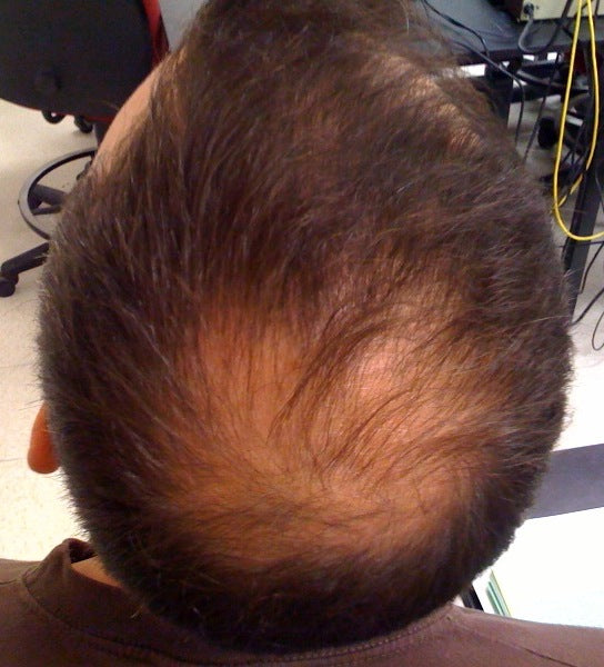 Is There A Role For Nutrition In Dealing With Hair Loss?
