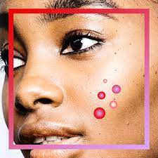 Acne & Stress - Why Suffer in the first place?