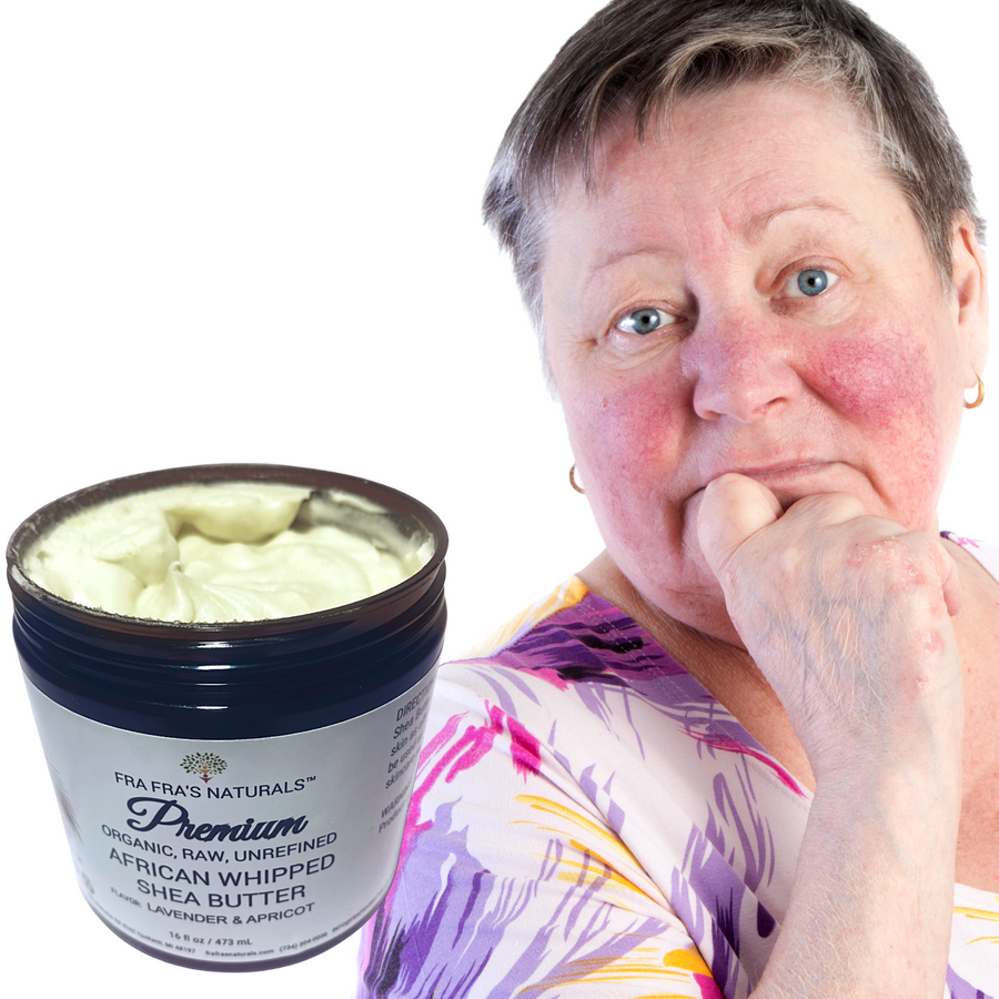 Fra Fra's Naturals | Premium Extreme Healing Rosacea Organic Raw Shea Butter
