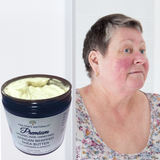 Fra Fra's Naturals | Premium Healing Rosacea Whipped Shea Butter