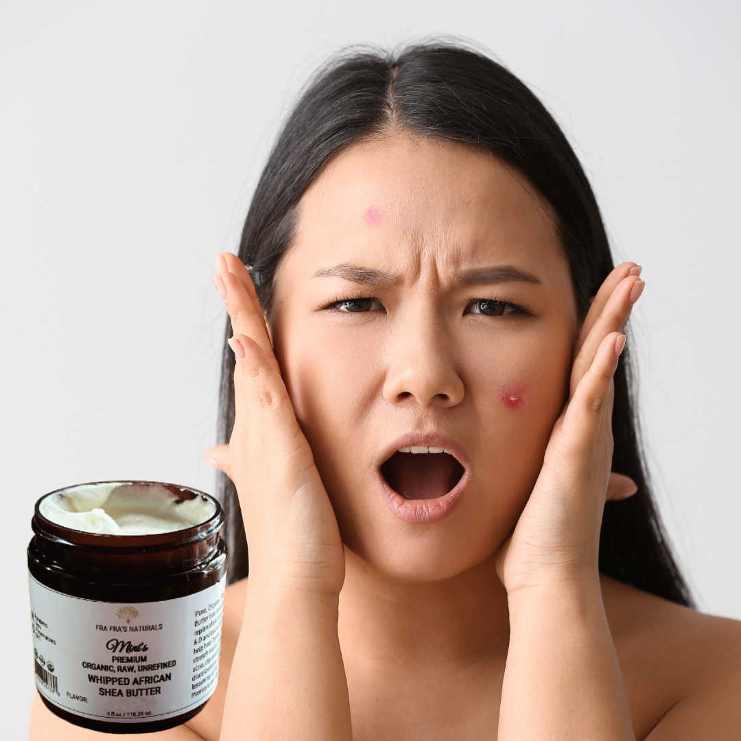 Fra Fra's Mini's | Premium EXTREME Healing Acne Whipped Shea Butter Blend - 4 oz