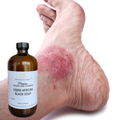 Fra Fra's Naturals | Premium Extreme Healing Psoriasis Liquid African Black Soap Blend - 16 oz