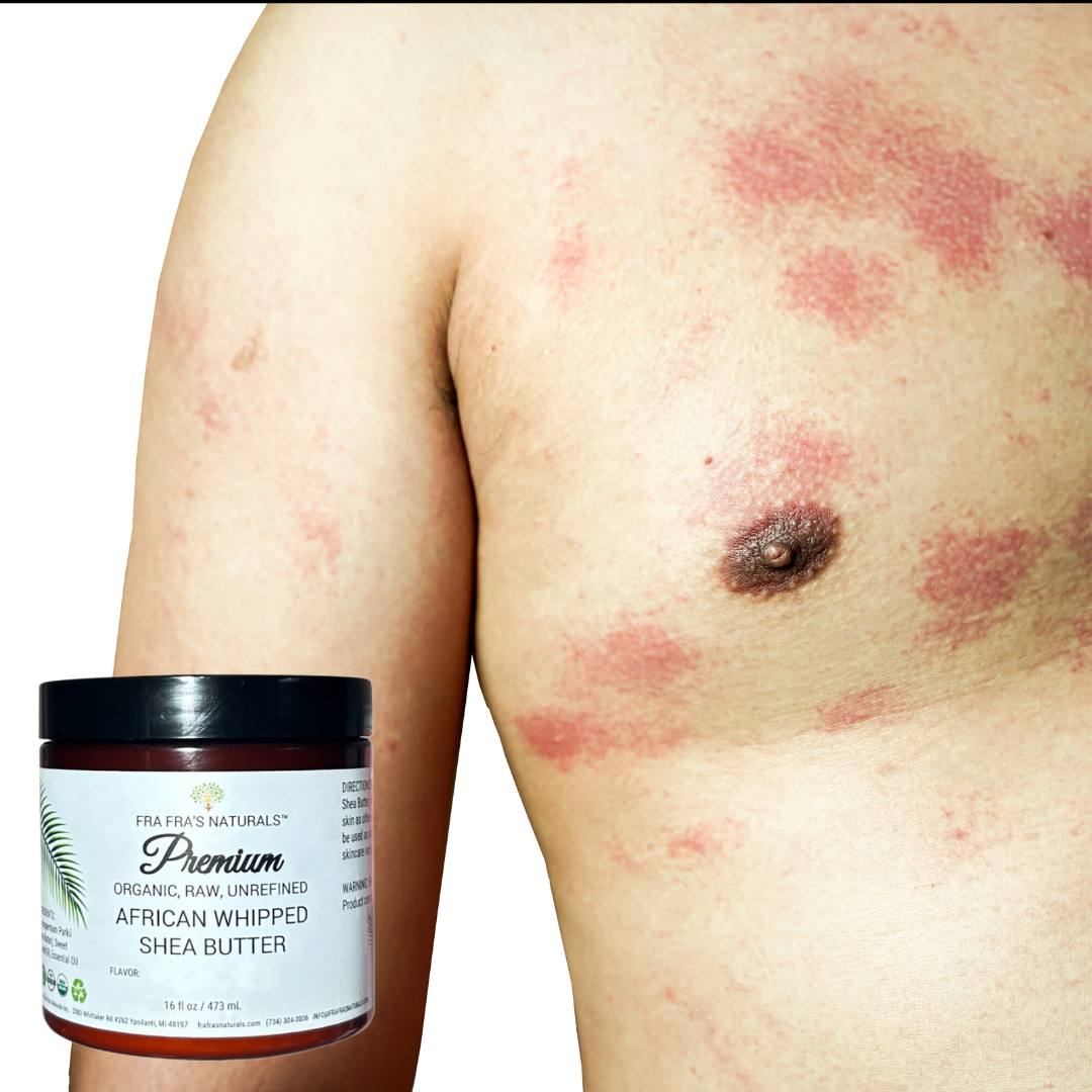 Fra Fra's Naturals | Premium Extreme Healing Psoriasis Blend Organic Whipped Shea Butter - 16 oz