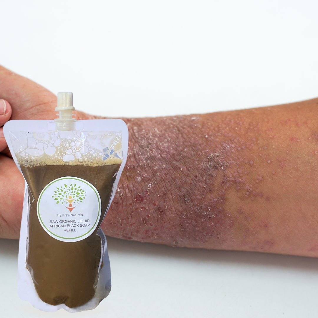 Fra Fra's Naturals | Premium Extreme Healing Psoriasis Liquid African Black Soap Blend - 16 oz