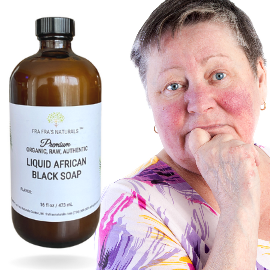 Fra Fra's Naturals | Premium Extreme Healing Rosacea Liquid African Black Soap