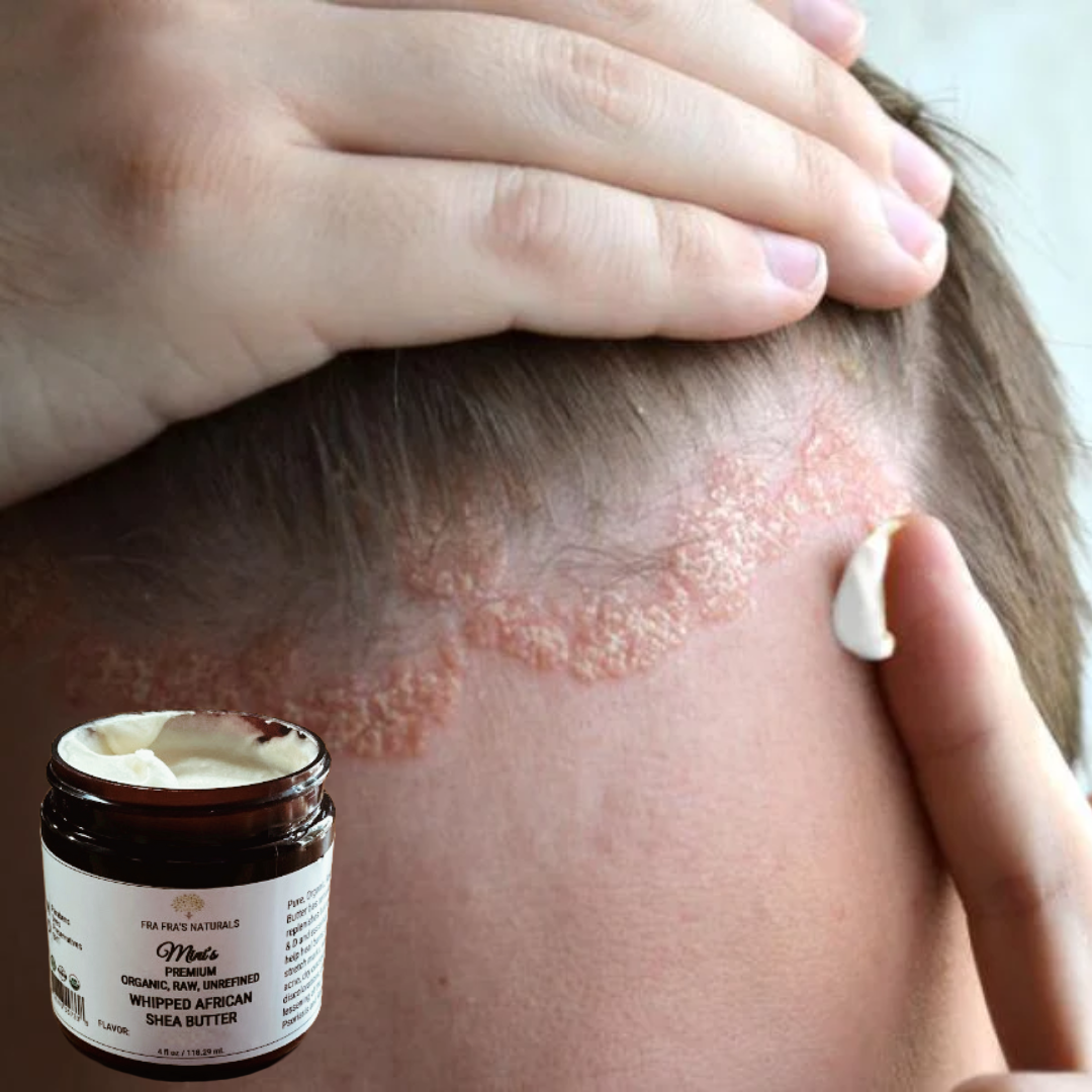 Fra Fra's Naturals I Premium EXTREME Healing Seborrheic Dermatitis Blend