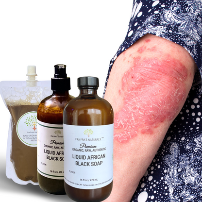 Fra Fra's Naturals | Premium Extreme Healing Psoriasis Liquid African Black Soap Blend - 16 oz