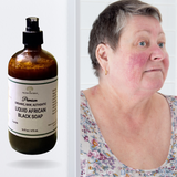 Fra Fra's Naturals | Premium Healing Liquid Black Soap Rosacea Blends