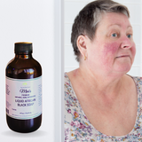 Fra Fra's Naturals | Premium Healing Liquid Black Soap Rosacea Blends