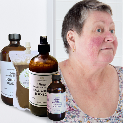 Fra Fra's Naturals | Premium Healing Liquid Black Soap Rosacea Blends