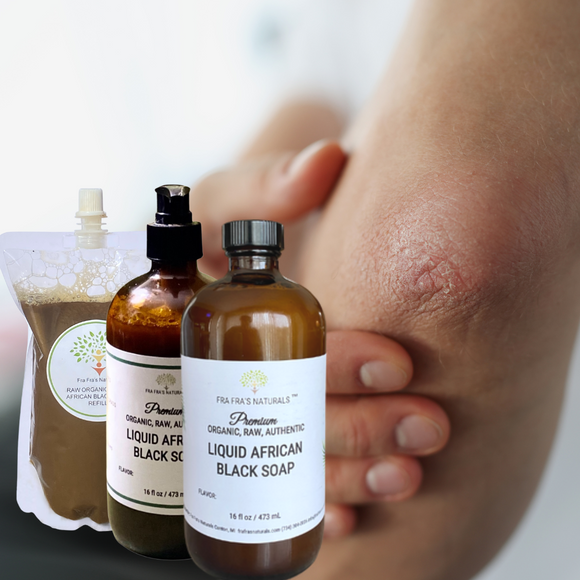 Fra Fra's Naturals | Premium Healing Psoriasis Organic Raw Liquid African Black Soap